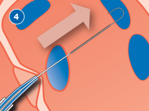 SafeSept Transseptal Needle Wire - Bisping Medizintechnik GmbH